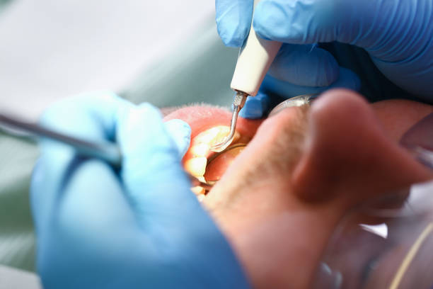 Best Broken or Cracked Tooth Emergency Dentist in Stockton, CA